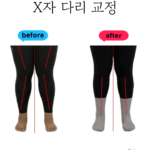 필라테스로 확인한 X자다리 교정 효과는?