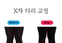 필라테스로 확인한 X자다리 교정 효과는?