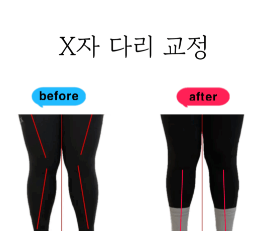 필라테스로 확인한 X자다리 교정 효과는?